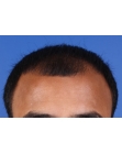Before Hair Transplant &nbsp;Front